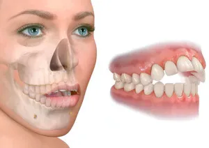Atypical Swallowing and Speech Therapy